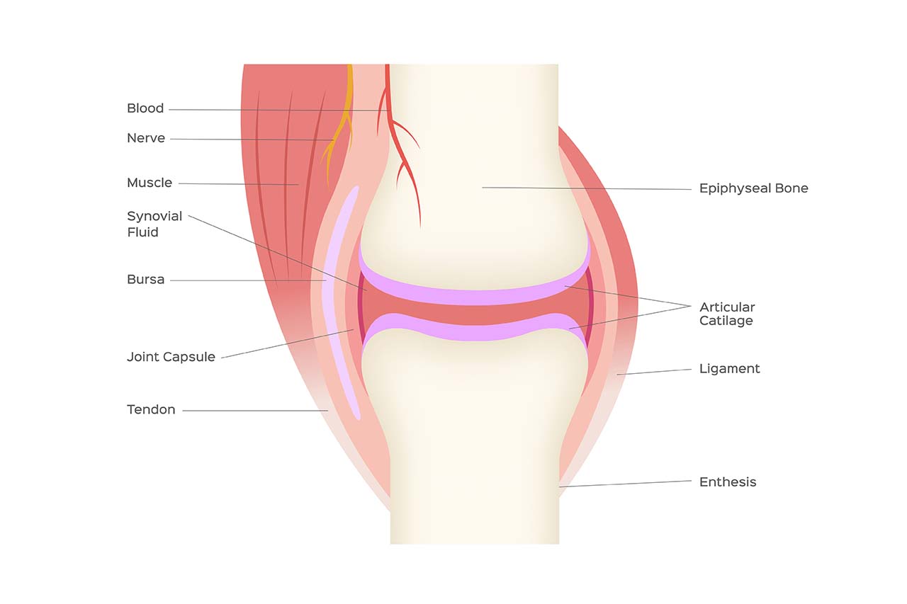 Medical illustration of tendinopathy, highlighting inflammation and degeneration in tendons, which can cause pain and affect mobility.